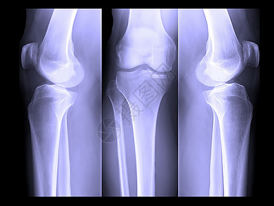 人体腿骨X光片诊所骨头放射学骨骼病人照片保健放射科掌骨指骨图片