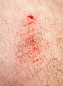膝盖上的划痕伤口头发疼痛皮肤图片