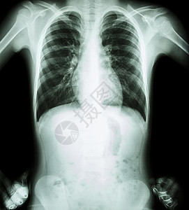 X射线胸akimbo阵地前视身体骨科卫生胸部医生肩膀解剖学骨骼疾病胸椎图片