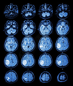 MRI 大脑 右脑叶上的脑瘤脑血管断层核磁共振医院肿瘤保健x射线扫描手术病人图片