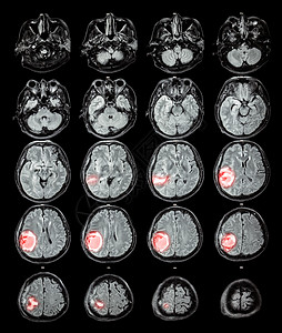 MRI 大脑 右脑叶上的脑瘤卫生男人医生电脑射线疾病科学扫描外科核磁共振图片