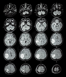 MRI 大脑 右脑叶上的脑瘤保健科学肿瘤扫描外科x射线电脑疾病卫生手术图片