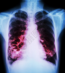 支气管扩张症传播男人囊肿肺炎细菌感染病人解剖学蓝色x光图片