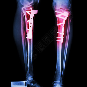 四肢骨折腿骨胫骨骨科卫生蓝色股骨盘子病人x光x射线手术图片