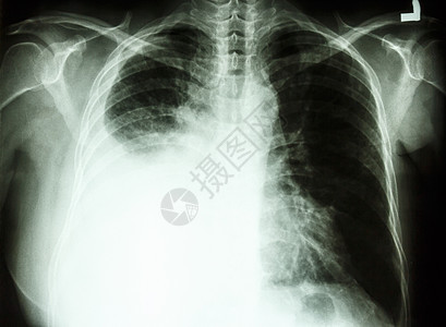 肺癌导致的胸膜破损保健液体解剖学积液疾病骨骼胸部医院扫描辐射图片