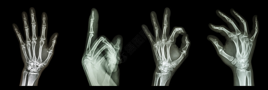 收藏X射线符号手疾病手臂身体数字骨骼事故射线x射线x光手术图片