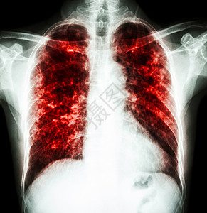 肺炎肺结核科学结核病医生卫生感染男人身体胸部死亡脊柱图片