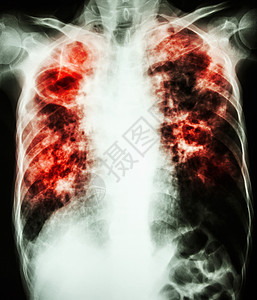 结核分枝杆菌感染 肺结核感染电影医生骨骼保健卫生医院男人结核病胸部图片