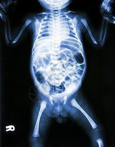 肠炎对生病婴儿的X光和肠炎医院感染孩子疾病放射科药品保健扫描医生骨骼图片