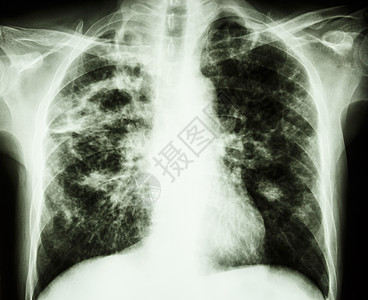 肺炎肺结核骨骼男人诊断空腔医院药品感染胸部纤维化x射线图片