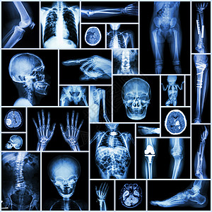 收集的X射线人体 矫形外科和多种疾病的多部部分Fracture 肺部科学解剖学胸部团体扫描手术医生手臂病人身体图片