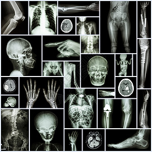 收集的X射线人体 矫形外科和多种疾病的多部部分Fracture 肺部扫描科学团体骨盆中风骨骼医生器官骨科手术图片