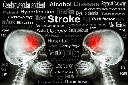 X射线Skull 带有Stroke和医疗文本脖子增值税医院卫生科学收藏医生颈椎病疾病药品图片