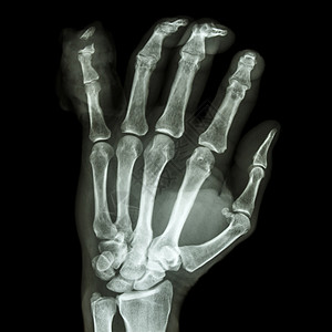 小手指骨折 断裂手腕男人碰撞电影医生药品数字科学棕榈骨科图片