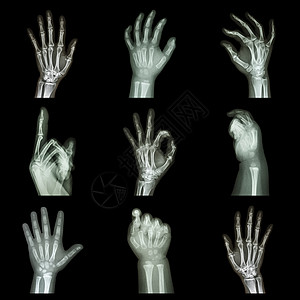 收集X光手相电影数字卫生前臂保健解剖学疾病骨科男人诊断图片
