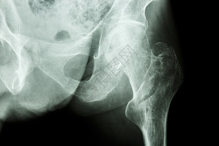 左大腿骨断裂痛苦考试疾病病人射线情况腰部男人卫生电影图片