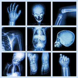 儿童身体的X光部分儿科药品放射科病人解剖学颅骨科学胸部骨科诊断图片