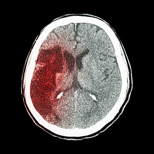 CT大脑 显示心电感应中风右前方的偏差麻痹诊断保健射线脑血管断层药品医院疾病医生图片