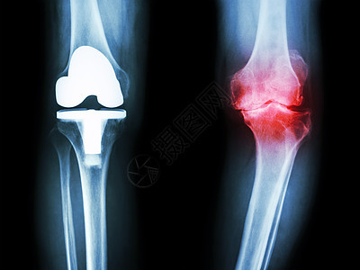 骨眼关节炎病人和人工关节的膝部成形术疾病假肢衰老放射科金属膝盖腓骨x光胫骨背景图片