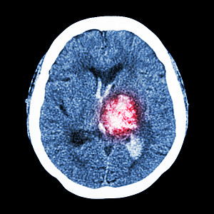 大脑计算CT大脑 显示左脑出血出血中风电影外科扫描卫生脑血管射线诊断事故中风医生背景