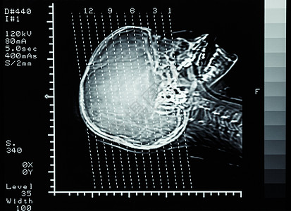 胶片CT扫描光谱断层摄影大脑 显示部分线电脑颅骨医院放射科卫生射线科学技术男人中风图片