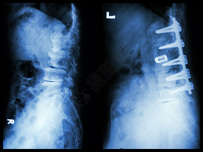 脊髓硬化左侧图象 病人在老人身上手术和内部固定 正确图象腰椎医生卫生疾病治疗骨骼恶化诊断外科骨科图片