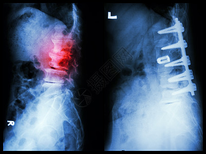 脊髓硬化左侧图象 病人在老人身上手术和内部固定 正确图象外科男人医生射线脊柱骨骼骨科骨干脊椎治疗图片