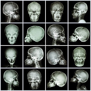 人类骨骼收集X光头骨亚洲人放射科创伤编译器官骨骼疾病科学药品诊断x射线背景