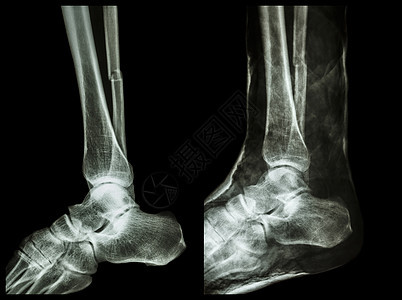 左图 腓骨 小腿骨 骨折轴 右图 用石膏固定碰撞诊断治疗疾病胫骨射线扫描病人x光疼痛图片