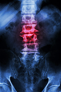 老年病人和脊椎炎的松发性硬化薄膜X射线LS脊椎乳液囊骨骼腹部男人外科射线骶骨保健脊椎腰椎解剖学图片