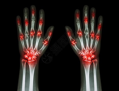 黑色背景的双手Gout 风湿多重关节炎疾病外科x射线药品医生手指骨骼痛风数字棕榈图片