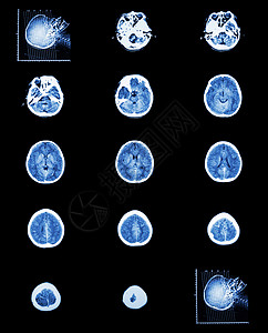 正常大脑脑血管的CT扫描计算断层摄影电脑医生增值税身体射线颅骨骨骼男人卫生x射线图片