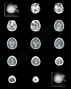 大脑计算正常大脑脑血管的CT扫描计算断层摄影增值税医生手术保健颅骨医院解剖学x射线男人疾病背景