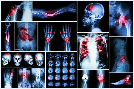 人类骨骼X-射线多种疾病 中风 脑血管意外 脑血管病 肺结核 骨折 肩关节脱位 痛风 类风湿性关节炎 脊椎病 骨关节炎 肠梗阻背景