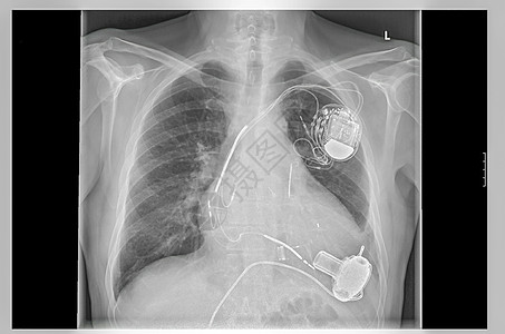 X光图像 链接 人工心脏起搏器图片