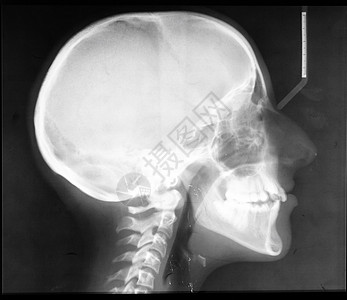 X射X光头骨图片