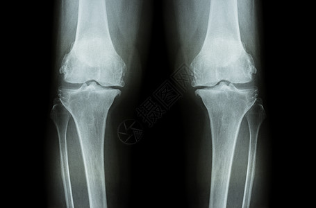 膝骨关节炎 OA 膝 双膝 X 光片 前视图 显示关节间隙狭窄 关节软骨丢失 骨赘 软骨下硬化病人扫描疗法手术药品电影骨科疼痛大图片