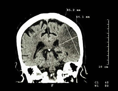左半球的脑进卵化学中风大脑CT扫描 医学和科学背景以及颅骨疼痛医院增值税电脑放射科x光外科梗死医生图片