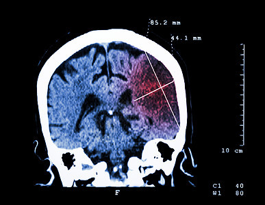 左半球的脑进卵化学中风大脑CT扫描 医学和科学背景以及诊断病人外科医院事故梗死医生创伤中风学家图片