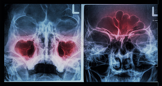 胶片 X 射线鼻旁窦 显示上颌窦 左图 额窦 右图 的鼻窦炎疼痛解剖学外科诊断骨科x光卫生头痛疾病鼻子图片