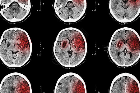 缺血性中风 脑CT显示左侧额颞顶叶脑梗塞 神经系统背景手术电脑病人事故颅骨脑血管外科医生医院断层图片
