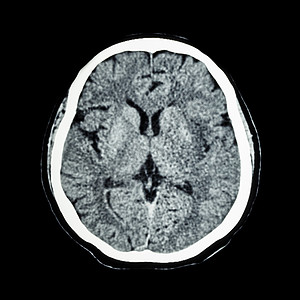脑部CT扫描 显示正常人的大脑CAT扫描事故疾病电脑断层创伤轴向中风手术神经电影图片