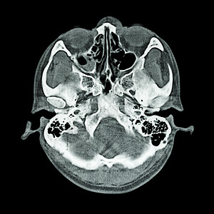 对大脑和头骨底部进行CT扫描骨窗放射科电影增值税诊断疼痛创伤电脑调查脑血管手术图片