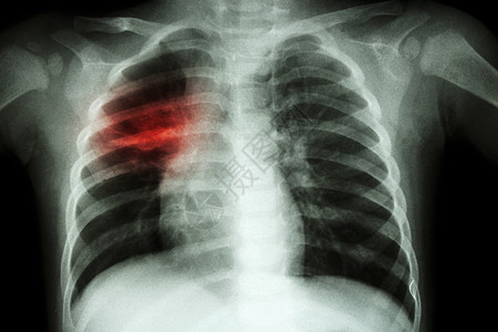 肺肺结核儿童胸前X射线 在右中肺部显示零散渗透结核病肋骨感染药品躯干身体疾病孩子诊断保健图片
