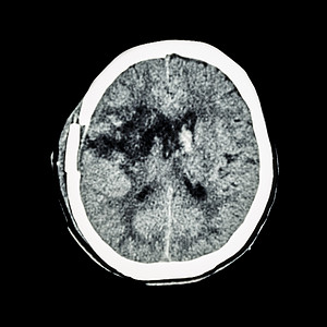 脑部CT扫描 用脑水肿显示旧右直脉冲突出血 脑外科手术后状态 出血中风病人增值税疼痛神经病放射科中风断层开颅颅骨大脑图片