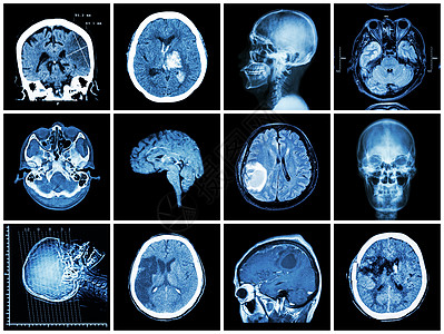 脑部疾病的集合 脑部 CT 扫描和 MRI 显示脑梗塞 脑出血 脑肿瘤 基底神经节出血 开颅术后状态 保健概念科学中风大脑电脑x图片