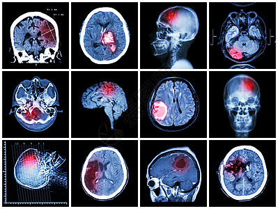 脑部疾病的集合 脑部 CT 扫描和 MRI 显示脑梗塞 脑出血 脑肿瘤 基底神经节出血 开颅术后状态 保健概念颅骨放射科大脑学家图片