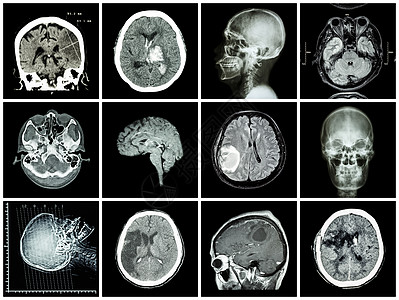 脑部疾病的集合 脑部 CT 扫描和 MRI 显示脑梗塞 脑出血 脑肿瘤 基底神经节出血 开颅术后状态 保健概念增值税科学x光核磁图片