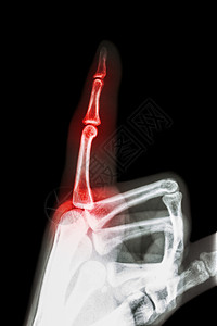 类风湿性关节炎 痛风性关节炎 拍摄 X 光食指和手 指向手指 并在手指处发炎方阵x光风湿病骨科指间风湿骨骼医生痛风医院图片