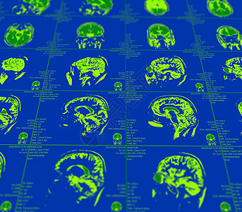大脑的磁共振成像 没有明显的反常现象 笑声x射线测试实验室电影技术断层解剖学放射科医院x光图片